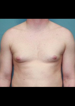 Male Breast Reduction#4029
