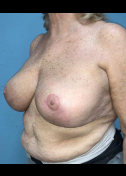 After Image: Breast Revision #2520 - other