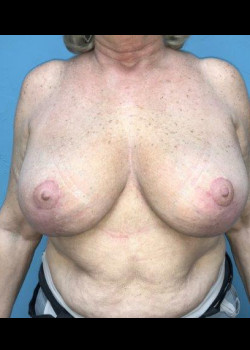 Breast Revision #2520