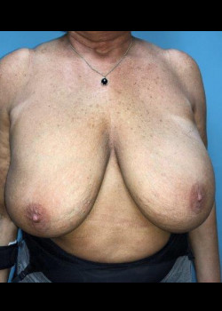 Breast Revision #2520