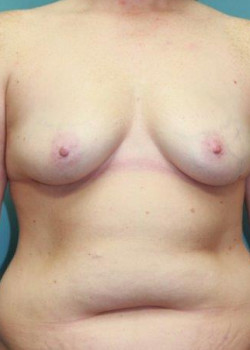 Before Image: Breast Augmentation #4140 - front