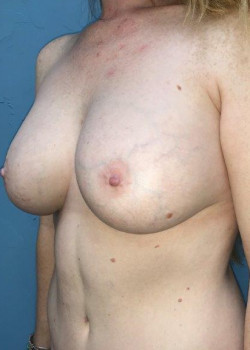 Breast Augmentation #4140