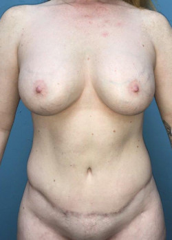 Abdominoplasty #4141