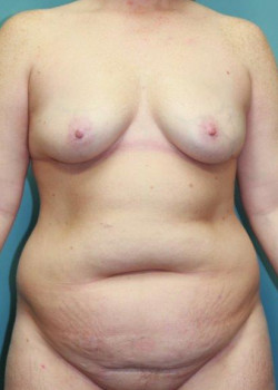 Abdominoplasty #4141