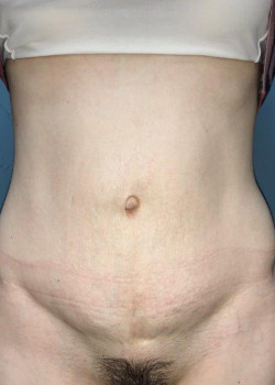 Abdominoplasty #4142