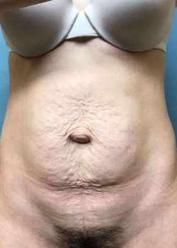 Abdominoplasty #4142