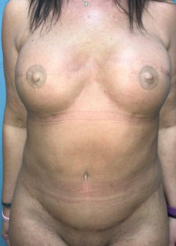 Abdominoplasty #4143