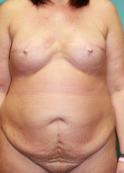 Abdominoplasty #4143