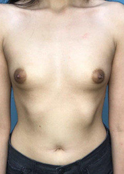 Breast Augmentation #4144