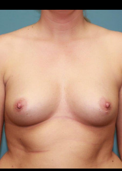 Breast Augmentation #4145