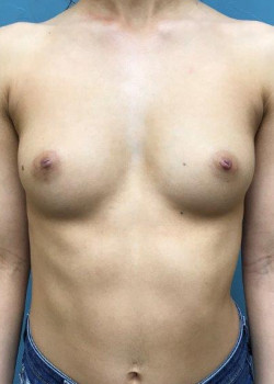 Breast Augmentation #4147