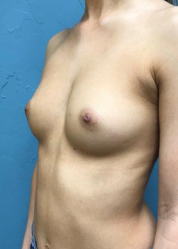 Breast Augmentation #4147