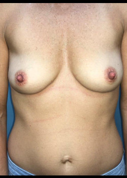 Breast Augmentation #4148