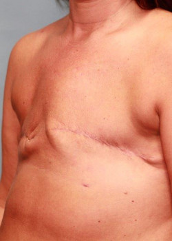 Before Image: Breast Reconstruction #4150 - other