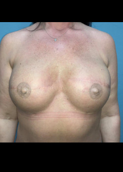 After Image: Breast Reconstruction #4150 - front