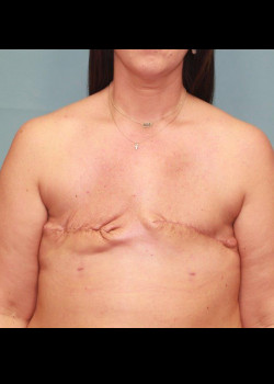 Breast Reconstruction #4150