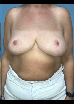 Breast Reduction #4151