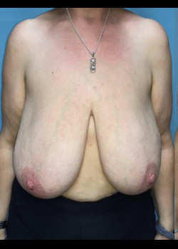 Breast Reduction #4151