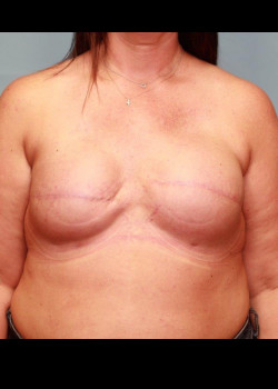 Fat Grafting To Breast #4164