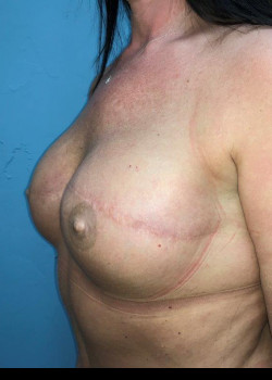 After Image: Fat Grafting To Breast #4164 - other