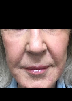 After Image: Croton Oil Peel #4202 - front