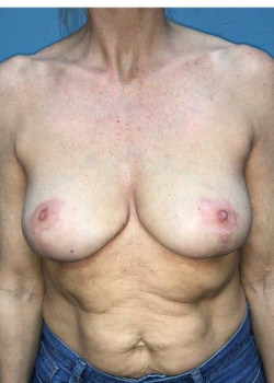 Breast Reduction #4214