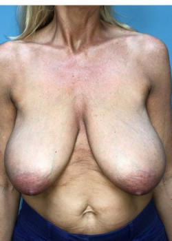 Breast Reduction #4214