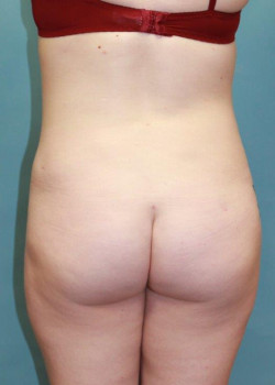 Liposuction: Flank Area #4231