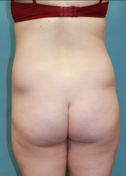 Liposuction: Flank Area #4231