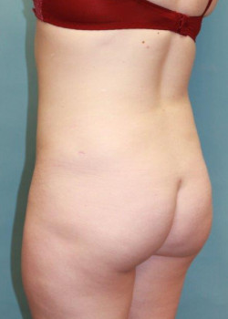 Liposuction: Flank Area #4231