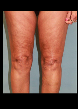 Liposuction: Knee Area #4236