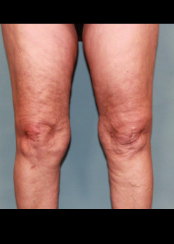 Liposuction: Knee Area #4236