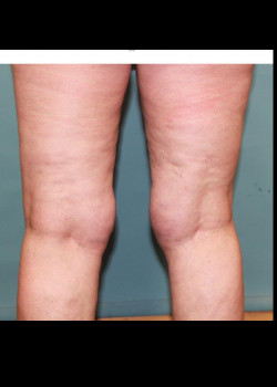 Liposuction: Knee Area #4236