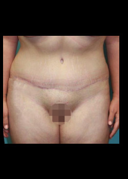 Tummy Tuck #4241