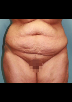 Tummy Tuck #4241