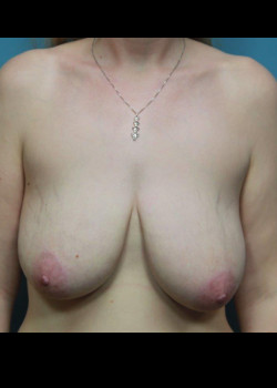 Breast Reduction #4256