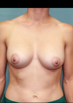 Breast Lift with Augmentation #4268