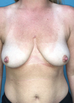 Breast Lift #4290