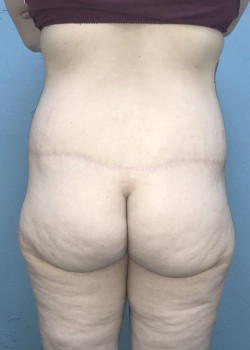 Posterior Thigh Lift #4328