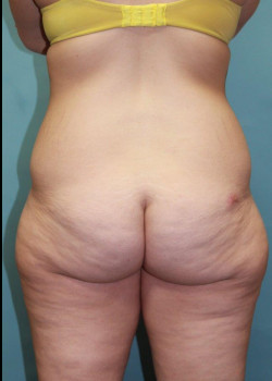 Posterior Thigh Lift #4328