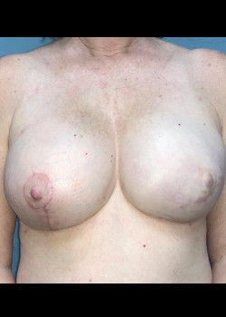 Fat Grafting Of The Breast #4341