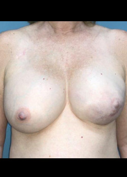 Fat Grafting Of The Breast #4341