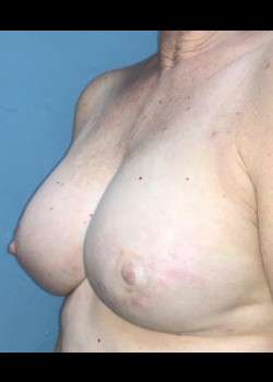 Fat Grafting Of The Breast #4341