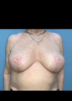 Breast Revision #4383