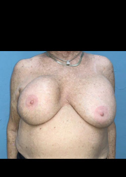 Breast Revision #4383