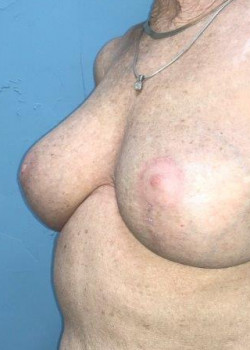 Breast Revision #4383