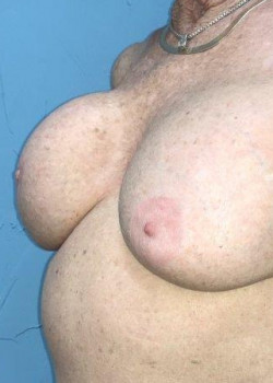 Before Image: Breast Revision #4383 - other