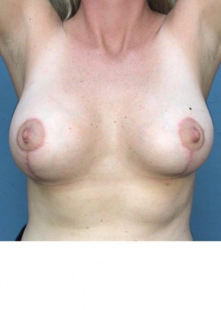 Breast Augmentation with Lift #4386
