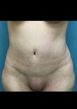 Abdominoplasty #4387