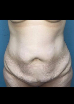 Abdominoplasty #4387